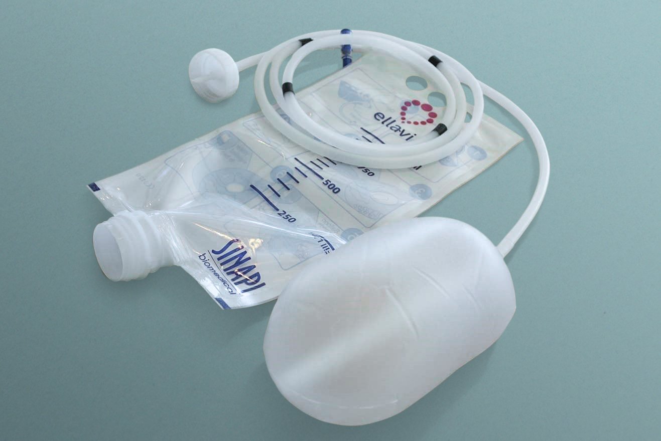 The Ellavi Uterine Balloon Tamponade. This device could save hundreds of thousands of lives. Photo: Sinapi Biomedical.